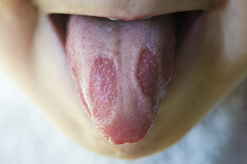 Глоссит (воспаление языка) у ребенка