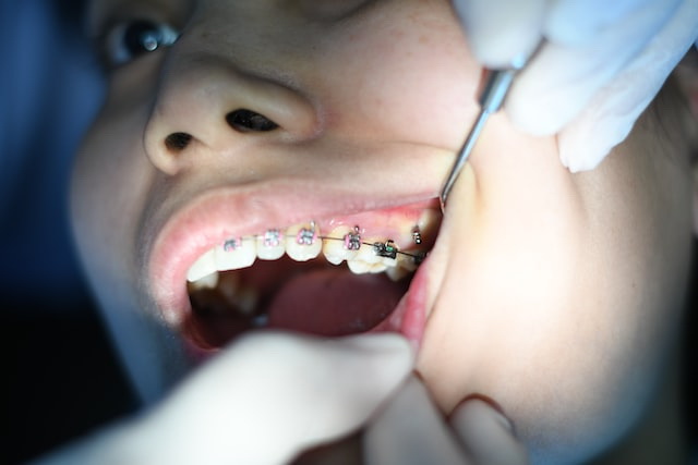 Профессиональная чистка зубов с брекет-системой